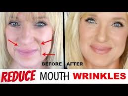 How To Get Rid Of Deep Mouth Wrinkles How To Reduce And Remove Mouth Wrinkles Khichi Beauty Youtube Mouth Wrinkles Lip Wrinkles How To Line Lips