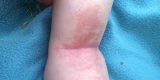 Image result for vyrážka u dětí