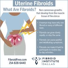 Uterine arteries with embolic particles, which block blood flow to the fibroids and cause fibroids to shrink. Symptoms From Fibroids Margo S Story Fibroid Institute Dallas