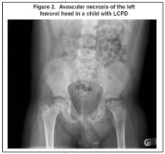 Image result for Pediatric Limp