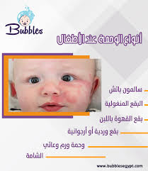 وحمة سمك السلمون و هي الاكثر شيوعا تظهر على الجفن او الشفة العيا او بين الحاجبين و تختفي مع. Ø§Ù„ÙˆØ­Ù…Ø© Ø§Ù„ÙˆØ±Ø¯ÙŠØ© Ø¹Ù†Ø¯ Ø§Ù„ÙƒØ¨Ø§Ø±