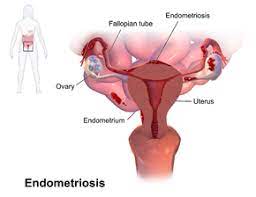 Endometriosis means the development of endometrial tissue inside the endometrial cavity as well as other parts of the myometrium. Endometriosis Wikipedia