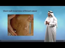 A new lump in the breast a new area of the breast that seems unnaturally firm redness or swelling of the skin in or around the breast area Chest Wall Recurrence Of Breast Cancer Youtube