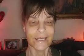 Fundraiser for Cheryl Steneck by Carly Fleming : Emergency dental work for  Cheryl