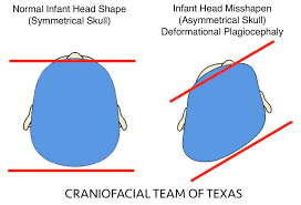 Image result for Positional Head Deformity