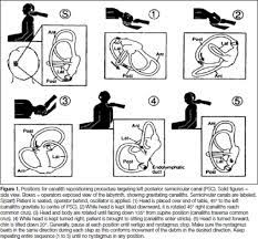 This is a great technique to use for benign paroxysmal positional vertigo. Can Gps Diagnose Benign Paroxysmal Positional Vertigo And Does The Epley Manoeuvre Work In Primary Care British Journal Of General Practice