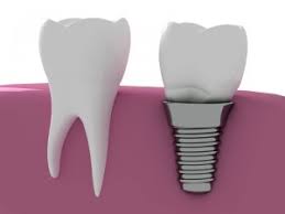 Medicare does not cover any oral care. Are Dental Implants Covered By Insurance Texas Wisdom Blog