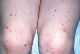 Image result for scabies in the groin area