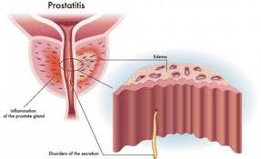 Image result for Acute Bacterial Prostatitis
