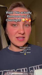 High Frequency Acne Before and After