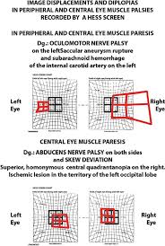 eye movement disorders related to brainstem dysfunctions