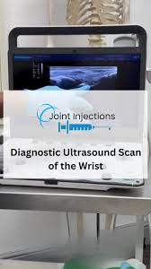 Image result for TFCC Steroid Injection