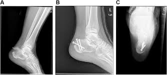 Image result for Calcaneus Compression Fracture