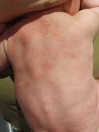 Image result for sweat rash on back baby