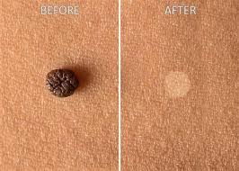 7 Natural Remedies For Skin Tags Eve Woman