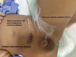 Image result for Urethral Catheterization