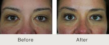 Once the treatment is applied with the applicator, it. Xanthelasma Removal 1 Carolina Facial Plastics