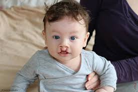 schisis hazenlip ~ Leyla Ummels