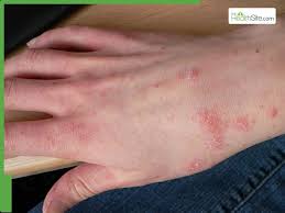 Image result for what does scabie look like