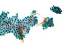 The cause of fibrocystic breast disease according to dr. Fibrocystic Breast Changes Wikipedia