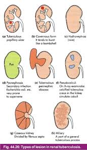 Image result for Genitourinary Tuberculosis