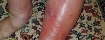 Image result for phlegmon of hand)