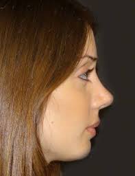 Rhinoplasty