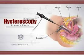 Check spelling or type a new query. Listra Malaysia Hysteroscopy Cara Untuk Doktor Melihat Lapisan Dalam Rahim Dengan Mengunakan Satu Alat Khas Yg Mempunyai Berkamera Kecil Dihujungnya Ia Adalah Prosedur Kecil Yang Membolehkan Pesakit Pulang