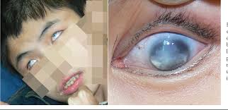 Figure 1 from A novel nonsense mutation in the NDP gene in a Chinese family  with Norrie disease