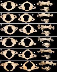 The atlas and axis are specialized to allow a. Variants Of The Posterior Arches Of The Atlas Vertebra Viewed From Download Scientific Diagram
