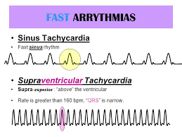 Fast Arrythmias Sinus Tachycardia Fast Sinus Rhythm Supraventricular Tachycardia Supra Superior Above Sinus Tachycardia Ekg Rhythms Ventricular Tachycardia
