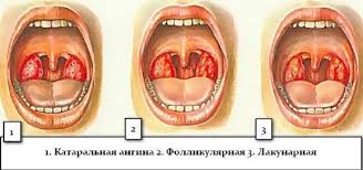 Gnojnaya Angina Simptomy I Lechenie Citovir 3