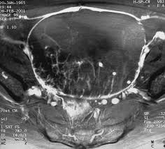 Ct And Mr Imaging Of Ovarian Tumors With Emphasis On Differential Diagnosis Radiographics