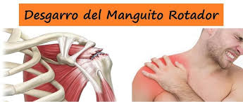 Desgarro O Rotura Del Manguito Rotador Manguito Rotador Manguito De Los Rotadores Salud Laboral