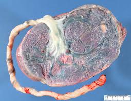 Marginal cord insertion is not considered high risk as there is no medical risk to the baby and to the mother. Umbilical Cord Insertion Humpath Com Human Pathology