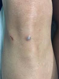 Image result for Glomus tumor