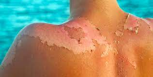 In rare cases, people with sunburn may also experience an extreme, deep, painful itching called hell's itch. Sunburn Peeling How To Stop Sunburn Peeling Fast And Safely