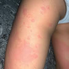 Image result for Multisystem Inflammatory Syndrome