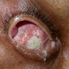 Evaluation Of The Anophthalmic Socket