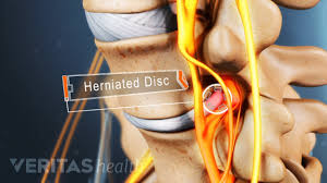 How Microdiscectomy Surgery Is Performed Herniated Disc Disc Herniation Lumbar Radiculopathy