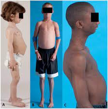 Maladies rares infos services est le service d'information et de soutien de référence sur les maladies rares. Genetics Of Lipodystrophy Abstract Europe Pmc