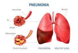 Image result for Pneumonia