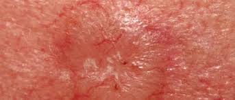 According to the american cancer society, just over 100,000 new cases of skin cancer are diagnosed in the united states each year. Skin Cancer Signs And Symptoms In Older Patients