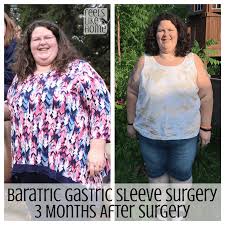 bariatric gastric sleeve surgery 3 5