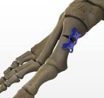 Orthopedic Locking Plate, Foot and Ankle Implant - Loc Plate ...