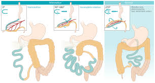 Image result for Intestinal Malrotation