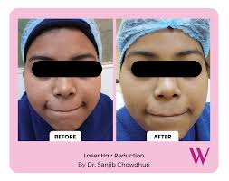 Bikini Laser Hair Reduction