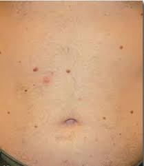 If you have excess body hair then laser hair removal is a good solution for you. Laser Hair Removal San Diego Permanent Laser Hair Removal Laser Hair Removal Permanent Laser Hair Removal Hair Removal