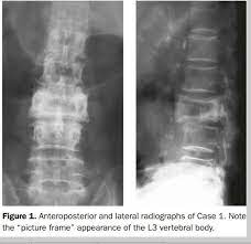 The human spine is composed of 33 vertebrae that interlock. Picture Frame Vertebra In Paget Disease Pagets Disease Paget Disease