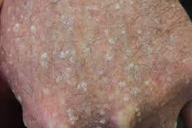 Maybe you would like to learn more about one of these? Stucco Keratosis Causes Symptoms Diagnosis Treatment